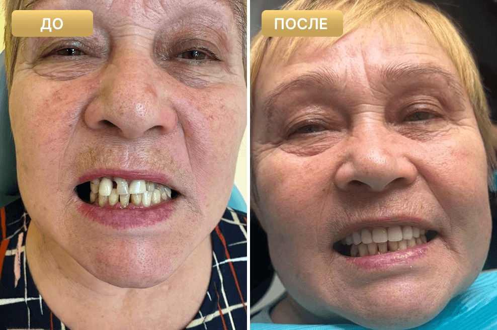 Результат лечения до и после, случай 5